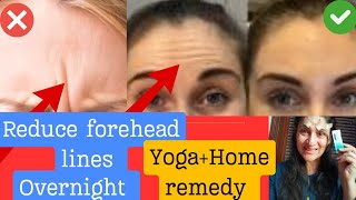 Smooth deep forehead lines over night  Inexpensive Home treatment [upl. by Tom844]