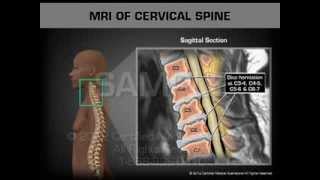 MRI of Cervical Spine [upl. by Anisor243]