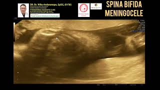 Spina Bifida Meningocele [upl. by Trotta]