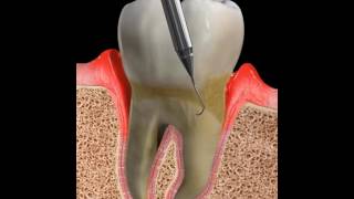 Periodontics Chemotherapeutics Periochip [upl. by Shelagh270]