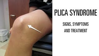 Plica syndrome Signs symptoms and treatment of this uncomfortable knee pain [upl. by Tterrab]