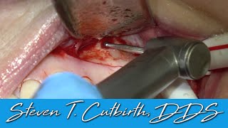 Maxillary 1st Molar Apicoectomy  Dental Minute with Steven T Cutbirth DDS [upl. by Kimberly610]