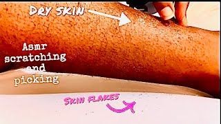 ASMR Peeling DRY SKIN FLAKES 🤯 Intense💤 [upl. by Cassandre]