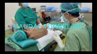 Caudal Tunelling [upl. by Arraik]