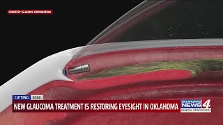 New glaucoma treatment is restoring eyesight in Oklahoma [upl. by Yanel]