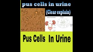 Why Pus Cells Comes In Urine  CuasesOfPusCells Causes Symptoms Treatment [upl. by Oicapot]