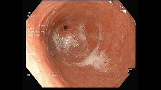 Gastric erosions Gastritis Endoscopy EsophagogastroduodenoscopyReflux esophagitisBiopsy Cancer [upl. by Garrison]