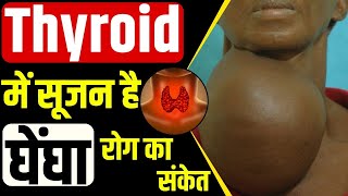 Goiter Causes Diagnosis Symptoms and Treatment  क्या है घेंघा रोग  Dr Kanchan Singh। [upl. by Ultun736]