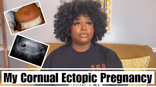 MY CORNUAL ECTOPIC PREGNANCY amp SALPINGECTOMY STORY  QUEEN JA’VON [upl. by Rj]