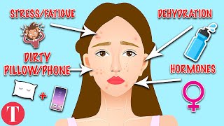 10 Types Of Acne And What They Mean [upl. by Acirred]