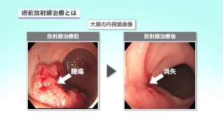 大腸がんの治療法～放射線治療～ [upl. by Enelam]