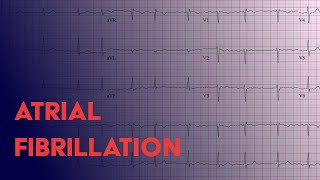 Atrial Fibrillation Afib  EKG ECG Interpretation [upl. by Misab]