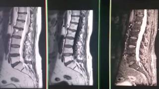 Resonancia magnetica de columna lumbar y columna dorsal [upl. by Nosnorb]