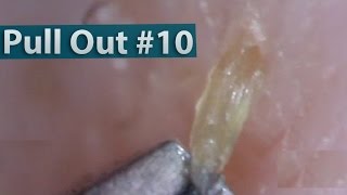 10 Pull Out Blackheads Close up  Blackheads Removal [upl. by Limoli535]