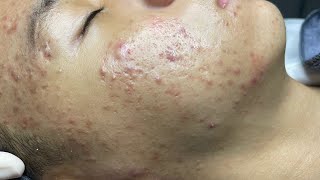 ACNE TREATMENT VU QUYNH MI  Perennial Blackheads On Boy Face 2024FULL [upl. by Luehrmann247]