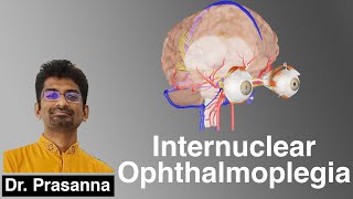 Internuclear Ophthalmoplegia [upl. by Legyn]