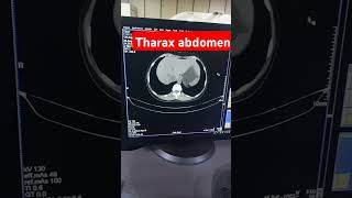 Thorax abdomen ct scan anatomy ct scanabdomenctanatomy ct scan [upl. by Cl]