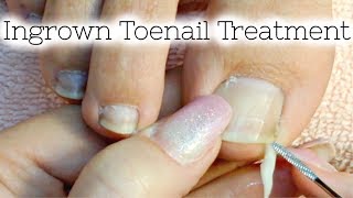 Pedicure Tutorial Ingrown Toenail Treatment At Home How to Recut Nail Groove to Eliminate Pain [upl. by Enitsahc615]