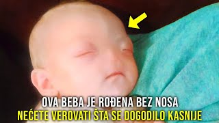 OVA BEBA JE ROĐENA BEZ NOSA ALI NEĆETE VEROVATI ŠTA JOJ SE DOGODILO POSLE 5 GODINA [upl. by Atteragram]