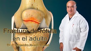 Fractura de rótula en el adulto [upl. by Susann526]