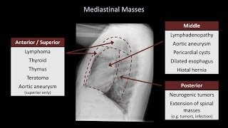 How to Interpret a Chest XRay Lesson 5  Cardiac Silhouette and Mediastinum [upl. by Carlynn878]