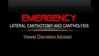 Emergency Lateral Canthotomy and Cantholysis [upl. by Nelyahs]