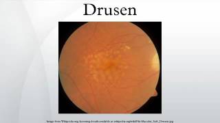 Drusen [upl. by Rawdin]