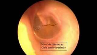 Otitis media Serosa con burbujas [upl. by Lednor307]