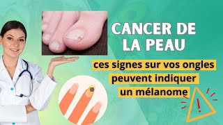 Comment détecter un mélanome en examinant ses ongles [upl. by Osnola846]