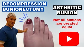 Decompression Bunionectomy Arthritic Bunion [upl. by Fanchan335]