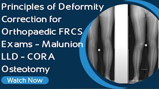 Principles of Deformity Correction for Orthopaedic FRCS Exams  Malunion LLD  CORA  Osteotomy [upl. by Astri375]