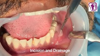 Incision and Drainage of Tooth Abscess Draining Pus [upl. by Atokad]