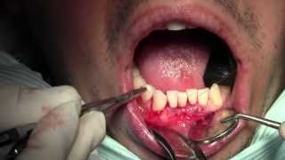 Alloderm Gingival Grafting 262524 Sling Suturing of Native Tissues [upl. by Darrelle370]