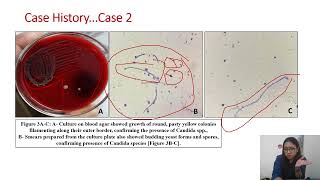 Candidiasis mimicking soft tissue lesion 2 cases at unusual location [upl. by Helena982]