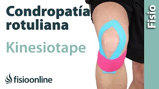 Kinesiotape para la condropatia o condromalacia rotuliana [upl. by Kano756]