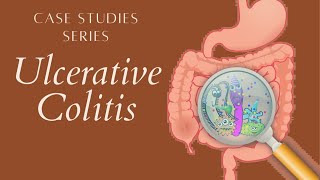 CaseStudy UllcerativeColitis Case Study of Ulcerative Colitis Pharmacists Perspective [upl. by Cicily]