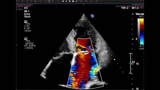 Flail AML leading to severe MR [upl. by Kred]