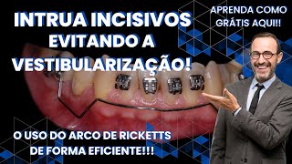 Como usar o arco de Ricketts para INTRUIR INCISIVOS sem causar a VESTIBULARIZAÇÃO  AULA 120 [upl. by Bradski479]