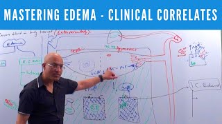 Mastering Edema  Types Causes Symptoms amp Treatment 👨‍⚕️ [upl. by Begga]