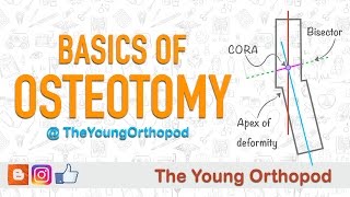 Basics of Osteotomy [upl. by Gausman216]