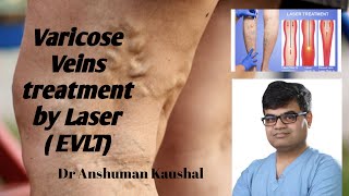 Varicose veins treatment explained  Laser treatment of Varicose veins  EVLT  वेरिकोस वेन्स उपचार [upl. by Oilisab]