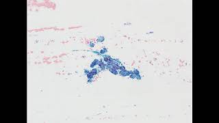 Parotid mass Acinic cell carcinoma Alcoholfixed smear [upl. by Akimas]