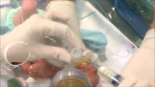 Neonatal Digital Intubation Part 2 [upl. by Aehtla]