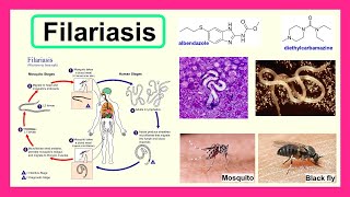 filariasis [upl. by Kristof374]