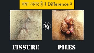 Piles vs Fissure  Difference [upl. by Tega]