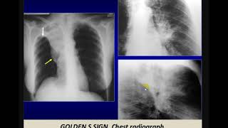 Imaging of bronchogenic carcinoma [upl. by Juley]