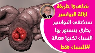 شاهدوا طريقة ازالة البواسيرللمرأة ستختفي البواسيربطرق تستهتربها السيدات لكنها فعالة في علاج البواسير [upl. by Ed]