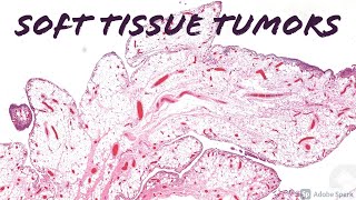 Soft Tissue Pathology epithelioid fibrous histiocytoma ALK1 atypical FH paraganglioma and more [upl. by Chassin26]