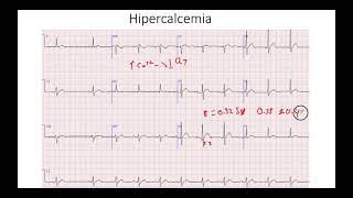 Hipocalcemia e hipercalcemia [upl. by Rorke148]