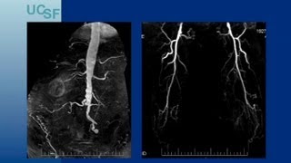 Endovascular Approaches for TASC CD Aortoiliac Lesions  UCSF Vascular Surgery Symposium 2013 [upl. by Neala]